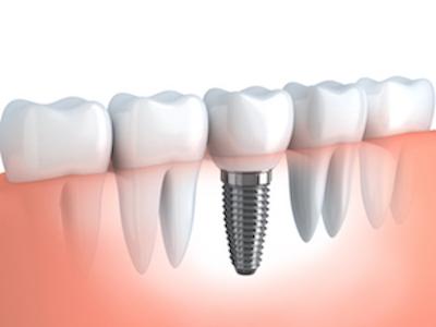 image of a dental implant in perth wa