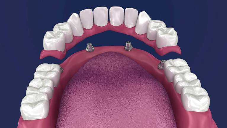 dental implants in perth