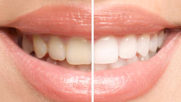 teeth whitening in perth